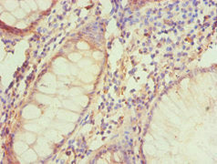 Immunohistochemistry of paraffin-embedded human colon cancer using CSB-PA002767ESR2HU at dilution of 1:100