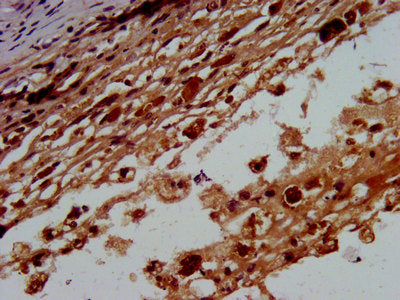 IHC image of CSB-PA002854LA01HU diluted at 1:400 and staining in paraffin-embedded human melanoma performed on a Leica BondTM system. After dewaxing and hydration, antigen retrieval was mediated by high pressure in a citrate buffer (pH 6.0). Secti...