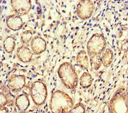 Immunohistochemistry of paraffin-embedded human gastric cancer using CSB-PA002882LA01HU at dilution of 1:100