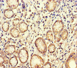 Immunohistochemistry of paraffin-embedded human gastric cancer using CSB-PA002882LA01HU at dilution of 1:100