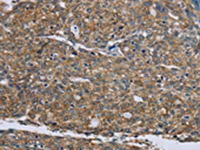 The image on the left is immunohistochemistry of paraffin-embedded Human ovarian cancer tissue using CSB-PA002912(KRT5 Antibody) at dilution 1/30, on the right is treated with fusion protein. (Original magnification: ×200)