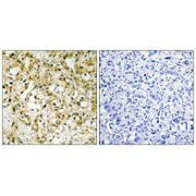 Immunohistochemistry analysis of paraffin-embedded human liver carcinoma tissue, using TFAM antibody.