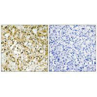 Immunohistochemistry analysis of paraffin-embedded human liver carcinoma tissue, using TFAM antibody.
