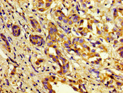 Immunohistochemistry of paraffin-embedded human liver cancer using CSB-PA003657LA01HU at dilution of 1:100