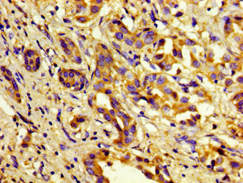 Immunohistochemistry of paraffin-embedded human liver cancer using CSB-PA003657LA01HU at dilution of 1:100