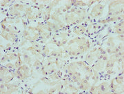 Immunohistochemistry of paraffin-embedded human gastric cancer using CSB-PA003758LA01HU at dilution of 1:100