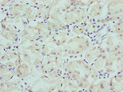 Immunohistochemistry of paraffin-embedded human gastric cancer using CSB-PA003758LA01HU at dilution of 1:100