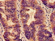 Immunohistochemistry analysis of human colon cancer using CSB-PA003773LA01HU at dilution of 1:100