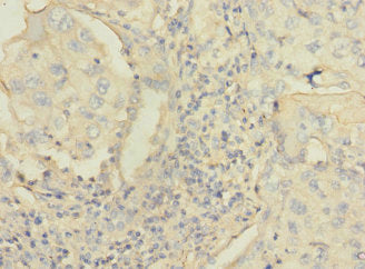 Immunohistochemistry of paraffin-embedded human lung cancer using CSB-PA003951LA01HU at dilution of 1:100