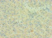 Immunohistochemistry of paraffin-embedded human liver cancer using CSB-PA003954ESR2HU at dilution of 1:100