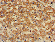 Immunohistochemistry of paraffin-embedded human liver cancer using CSB-PA003995LA01HU at dilution of 1:100