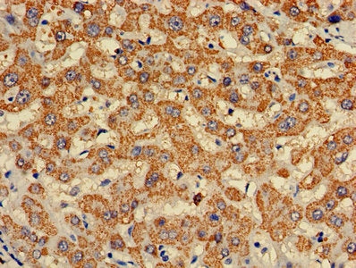 Immunohistochemistry of paraffin-embedded human liver cancer using CSB-PA003995LA01HU at dilution of 1:100