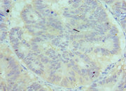 Immunohistochemistry of paraffin-embedded human colon cancer using CSB-PA004145ESR1HU at dilution of 1:100
