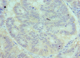 Immunohistochemistry of paraffin-embedded human colon cancer using CSB-PA004145ESR1HU at dilution of 1:100