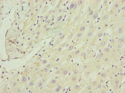 Immunohistochemistry of paraffin-embedded human liver cancer using CSB-PA004195ESR1HU at dilution of 1:100