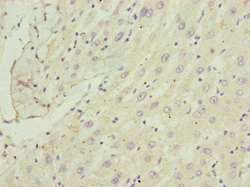 Immunohistochemistry of paraffin-embedded human liver cancer using CSB-PA004195ESR1HU at dilution of 1:100