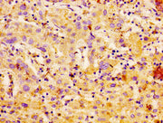 IHC image of CSB-PA004372LA01HU diluted at 1:100 and staining in paraffin-embedded human liver cancer performed on a Leica BondTM system. After dewaxing and hydration, antigen retrieval was mediated by high pressure in a citrate buffer (pH 6.0). S...