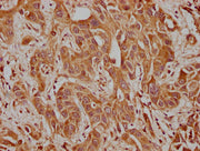 IHC image of CSB-PA004397LA01HU diluted at 1:100 and staining in paraffin-embedded human liver cancer performed on a Leica BondTM system. After dewaxing and hydration, antigen retrieval was mediated by high pressure in a citrate buffer (pH 6.0). S...
