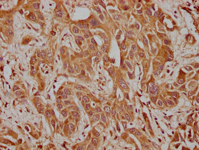 IHC image of CSB-PA004397LA01HU diluted at 1:100 and staining in paraffin-embedded human liver cancer performed on a Leica BondTM system. After dewaxing and hydration, antigen retrieval was mediated by high pressure in a citrate buffer (pH 6.0). S...