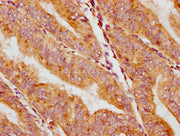 IHC image of CSB-PA004404EA01HU diluted at 1:400 and staining in paraffin-embedded human endometrial cancer performed on a Leica BondTM system. After dewaxing and hydration, antigen retrieval was mediated by high pressure in a citrate buffer (pH 6...