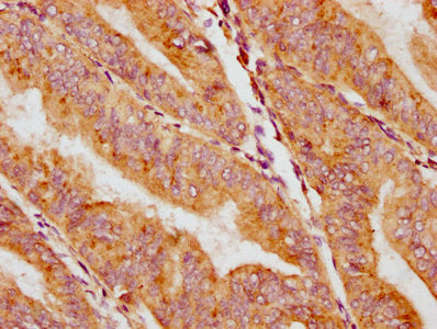 IHC image of CSB-PA004404EA01HU diluted at 1:400 and staining in paraffin-embedded human endometrial cancer performed on a Leica BondTM system. After dewaxing and hydration, antigen retrieval was mediated by high pressure in a citrate buffer (pH 6...
