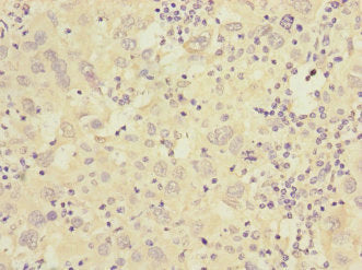 Immunohistochemistry of paraffin-embedded human liver cancer using CSB-PA004421ESR1HU at dilution of 1:100