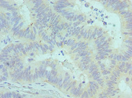 Immunohistochemistry of paraffin-embedded human colon cancer using CSB-PA004425ESR2HU at dilution of 1:100