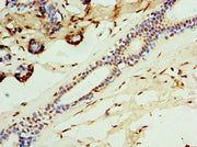 Immunohistochemistry of paraffin-embedded human breast cancer using CSB-PA004435ESR1HU at dilution of 1:100