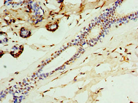 Immunohistochemistry of paraffin-embedded human breast cancer using CSB-PA004435ESR1HU at dilution of 1:100