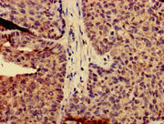 Immunohistochemistry of paraffin-embedded human ovarian cancer using CSB-PA004495HA01HU at dilution of 1:100