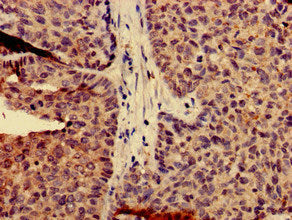 Immunohistochemistry of paraffin-embedded human ovarian cancer using CSB-PA004495HA01HU at dilution of 1:100