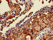Immunohistochemistry of paraffin-embedded human lung cancer using CSB-PA004512LA01HU at dilution of 1:100