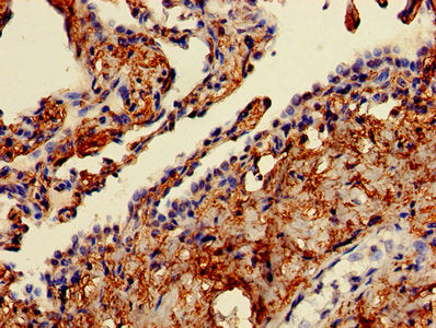 Immunohistochemistry of paraffin-embedded human lung cancer using CSB-PA004512LA01HU at dilution of 1:100