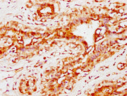 IHC image of CSB-PA004600EA01HU diluted at 1:300 and staining in paraffin-embedded human breast cancer performed on a Leica BondTM system. After dewaxing and hydration, antigen retrieval was mediated by high pressure in a citrate buffer (pH 6.0)....