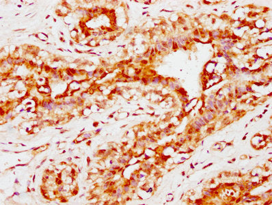 IHC image of CSB-PA004600EA01HU diluted at 1:300 and staining in paraffin-embedded human breast cancer performed on a Leica BondTM system. After dewaxing and hydration, antigen retrieval was mediated by high pressure in a citrate buffer (pH 6.0)....