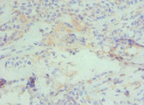Immunohistochemistry of paraffin-embedded human breast cancer using CSB-PA004600ESR2HU at dilution of 1:100