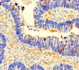 Immunohistochemistry of paraffin-embedded human ovarian cancer using CSB-PA004728LA01HU at dilution of 1:100