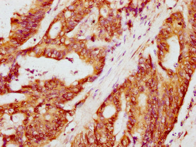 IHC image of CSB-PA004729LA01HU diluted at 1:300 and staining in paraffin-embedded human colon cancer performed on a Leica BondTM system. After dewaxing and hydration, antigen retrieval was mediated by high pressure in a citrate buffer (pH 6.0). S...