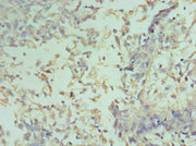 Immunohistochemistry of paraffin-embedded human cervical cancer using CSB-PA004812ESR2HU at dilution of 1:100