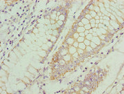 Immunohistochemistry of paraffin-embedded human colon cancer using CSB-PA004839LA01HU at dilution of 1:100