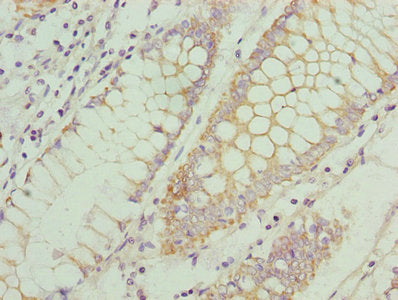 Immunohistochemistry of paraffin-embedded human colon cancer using CSB-PA004839LA01HU at dilution of 1:100