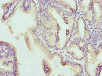 Immunohistochemistry of paraffin-embedded human prostate cancer using CSB-PA004890ESR2HU at dilution of 1:100