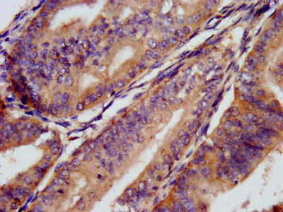 IHC image of CSB-PA004893LA01HU diluted at 1:300 and staining in paraffin-embedded human endometrial cancer performed on a Leica BondTM system. After dewaxing and hydration, antigen retrieval was mediated by high pressure in a citrate buffer (pH 6...