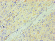 Immunohistochemistry of paraffin-embedded human liver cancer using CSB-PA004925ESR2HU at dilution of 1:100