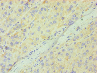 Immunohistochemistry of paraffin-embedded human liver cancer using CSB-PA004925ESR2HU at dilution of 1:100