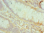 Immunohistochemistry of paraffin-embedded human colon cancer using CSB-PA004941ESR1HU at dilution of 1:100