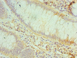 Immunohistochemistry of paraffin-embedded human colon cancer using CSB-PA004941ESR1HU at dilution of 1:100