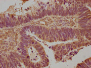 IHC image of CSB-PA004960NA01HU diluted at 1:100 and staining in paraffin-embedded human ovarian cancer performed on a Leica BondTM system. After dewaxing and hydration, antigen retrieval was mediated by high pressure in a citrate buffer (pH 6.0)....