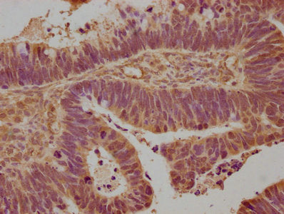 IHC image of CSB-PA004960NA01HU diluted at 1:100 and staining in paraffin-embedded human ovarian cancer performed on a Leica BondTM system. After dewaxing and hydration, antigen retrieval was mediated by high pressure in a citrate buffer (pH 6.0)....