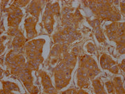 IHC image of CSB-PA004969LA01HU diluted at 1:100 and staining in paraffin-embedded human breast cancer performed on a Leica BondTM system. After dewaxing and hydration, antigen retrieval was mediated by high pressure in a citrate buffer (pH 6.0)....